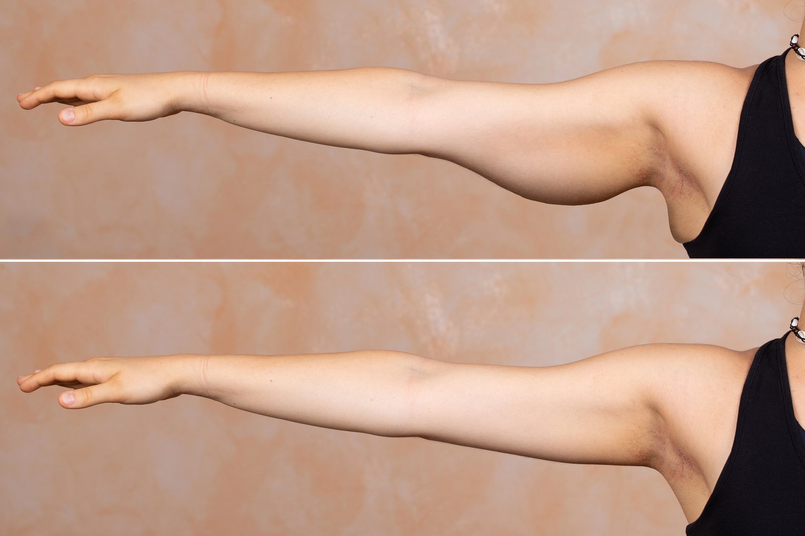 Body Contouring Body Contouring