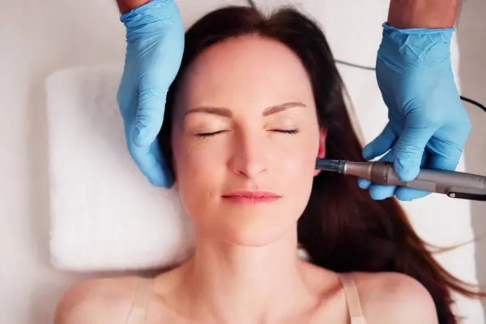 Microneedling Small