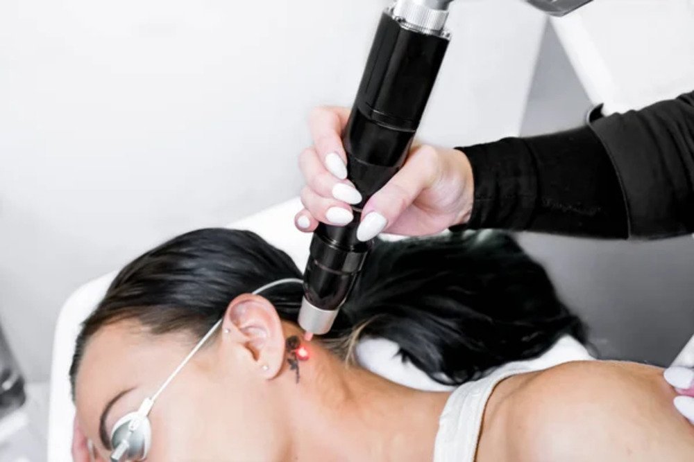Tatoo Removal Small.1 jpg