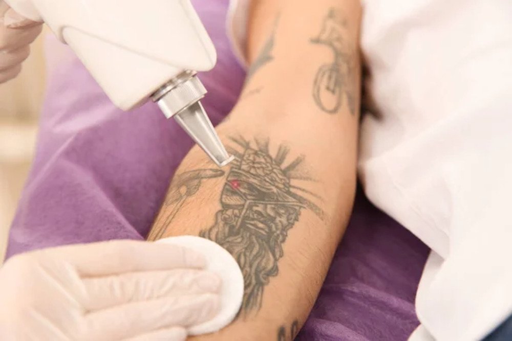 Tatoo Removal Small.2 jpg