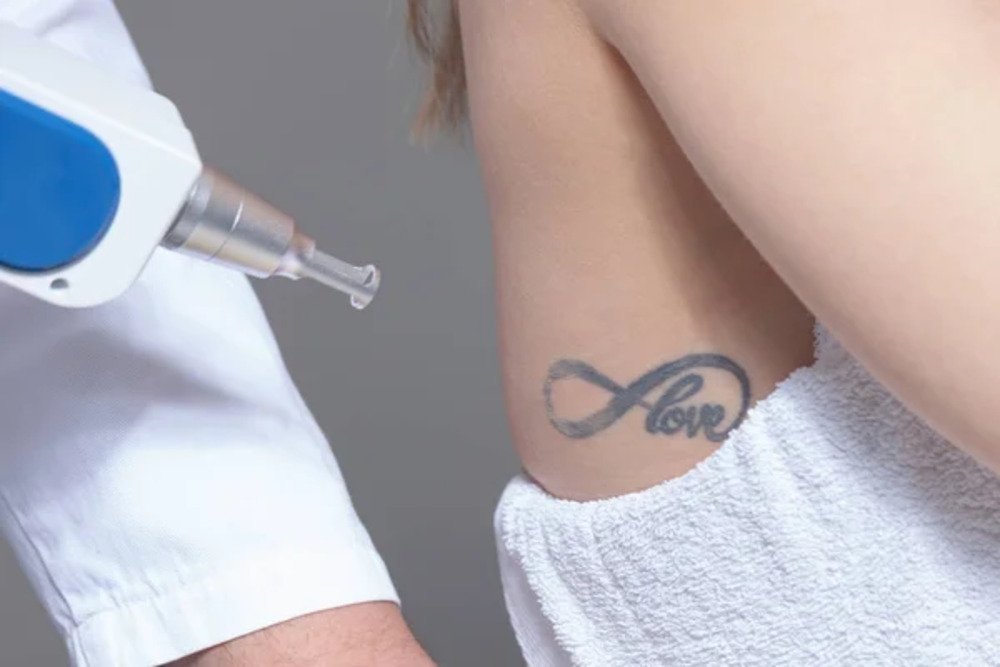 Tatoo Removal Small.3 jpg