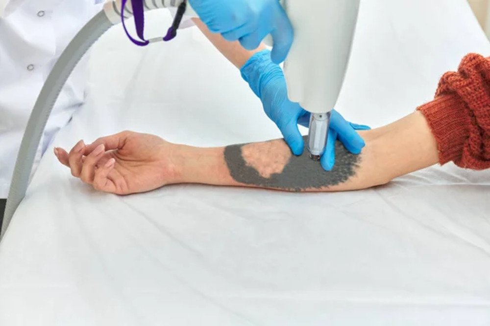 Tatoo Removal Small